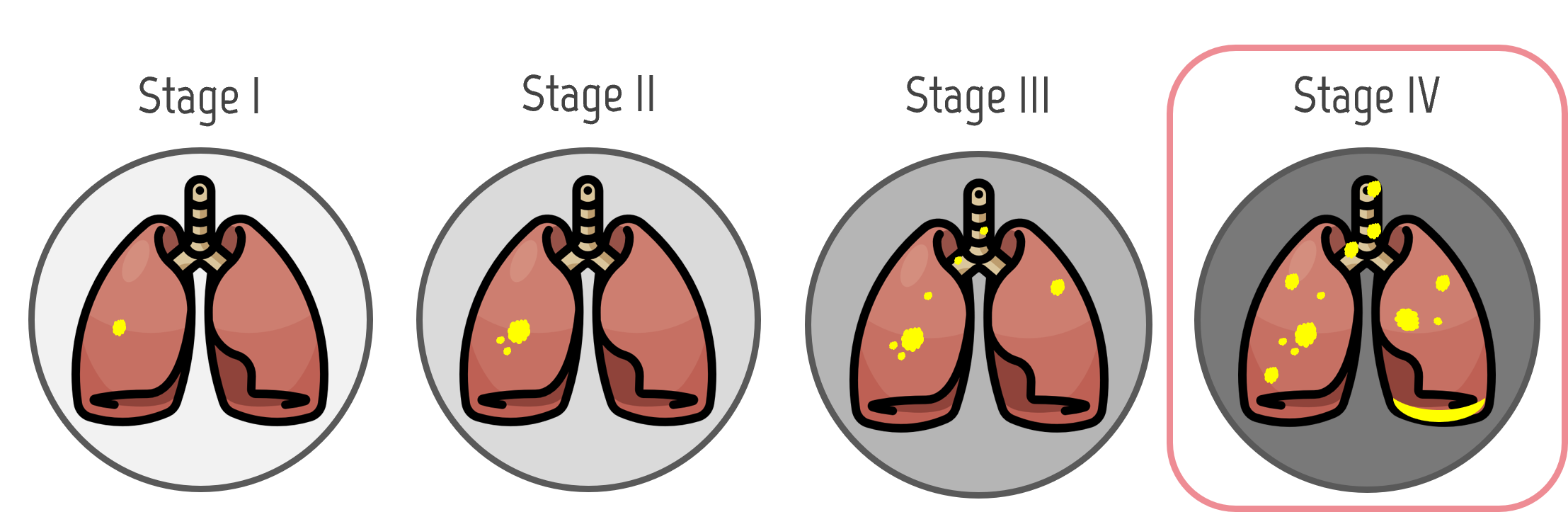 Lung cancer stages